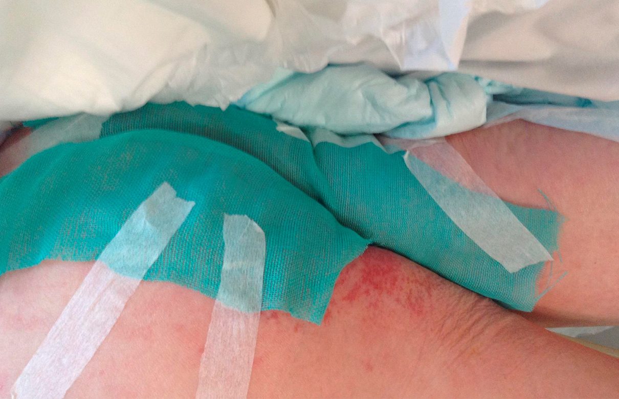 Sorbact-bandage påført hud med synlig hudirritation.