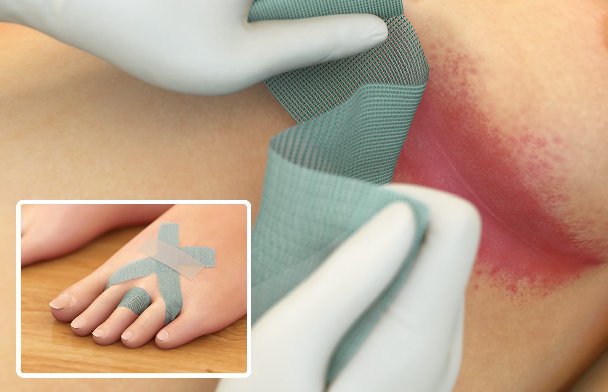 Illustration af en grøn Sorbact-bandage, der placeres i en rød hudfold. Indsat billede viser bandage placeret mellem tæer.