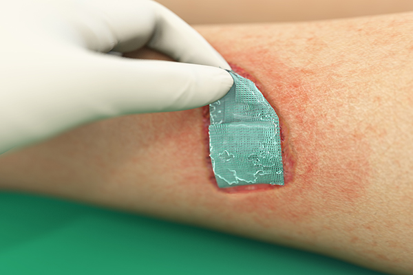 An illustrated hand applaying sorbact gel dressing onto a wound.
