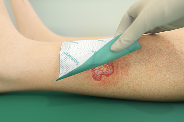 An illustration of Sorbact superabsorbent dressing over a wound.